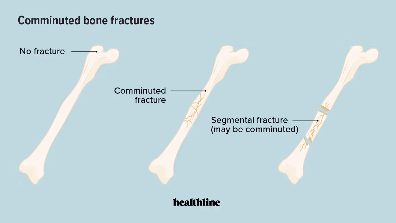 Bone Fractures: Causes, Types, and Recovery